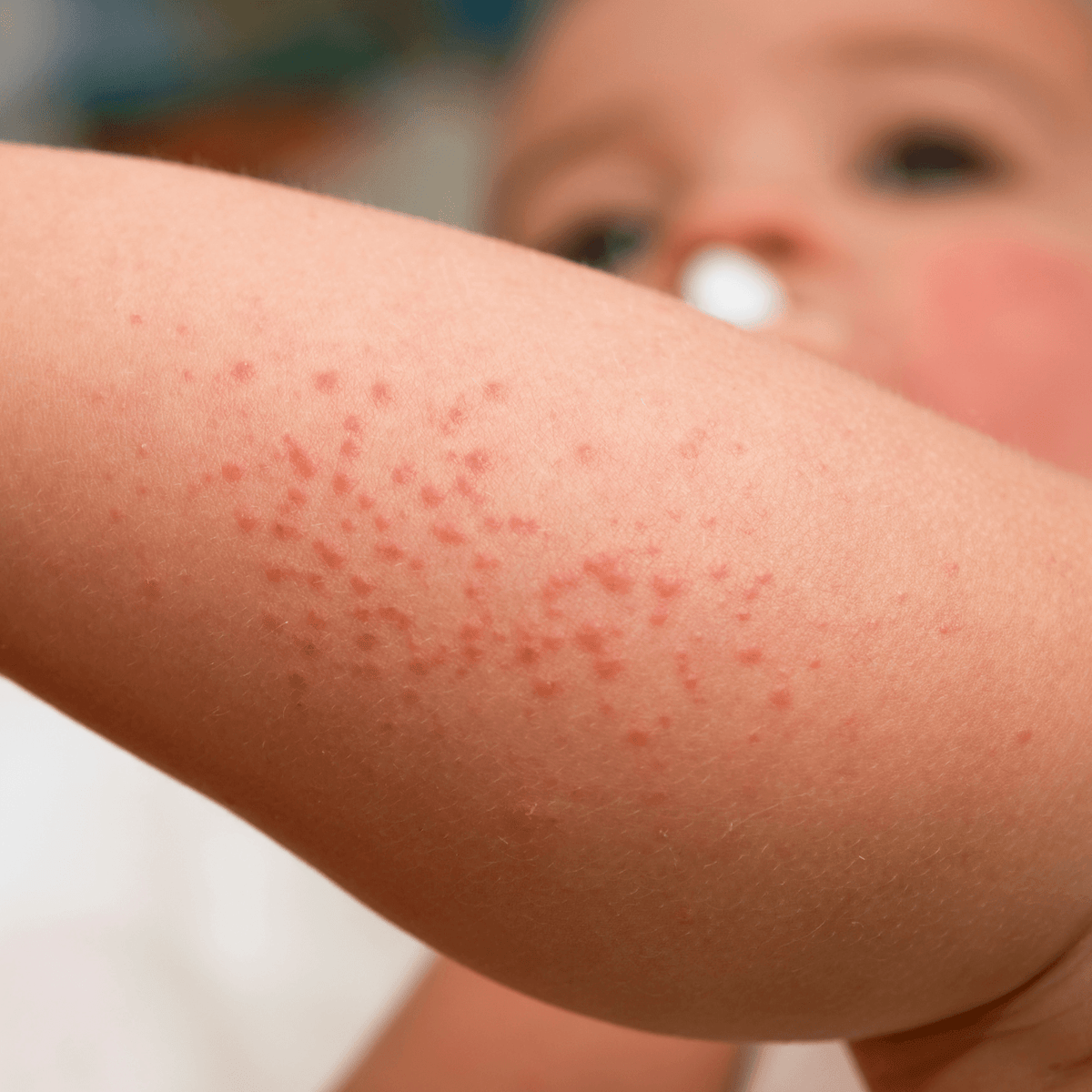 What Is Diaper Dermatitis